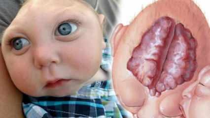 Apa itu Anencephaly? Apa saja gejala Anencephaly pada bayi dan anak-anak? Anencephaly menyebabkan ...