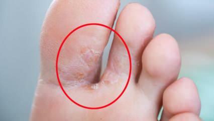 Apa itu jamur kaki? Apa saja gejala jamur kaki? Apakah ada obat untuk kaki atlet?