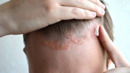 Apa saja gejala dermatitis seboroik dan siapa yang muncul? Makanan yang memicu penyakit