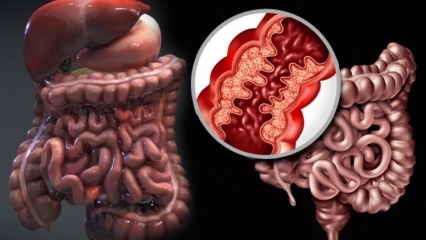 Apa itu penyakit Crohn? Apa saja gejala penyakit Crohn? Apakah ada obat untuk Crohn?