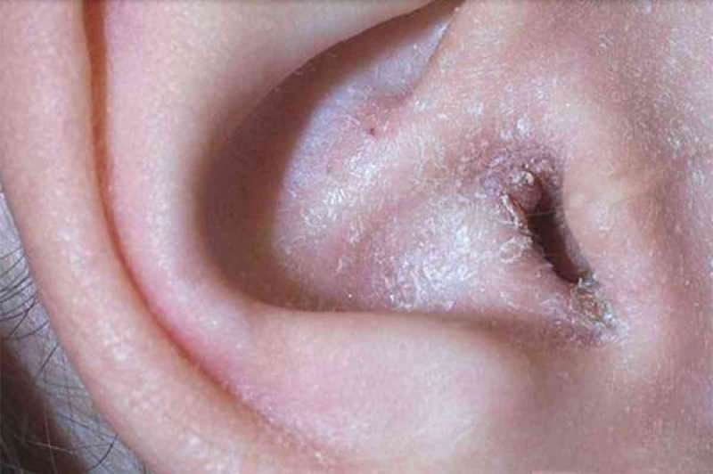 Apa penyebab mengelupas di belakang telinga dan bagaimana cara penularannya? Solusi definitif untuk eksim di belakang telinga ...