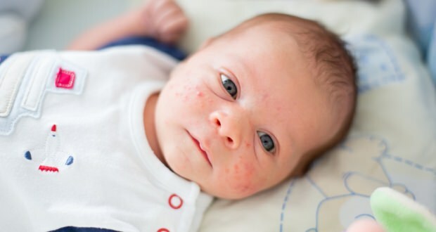 Bagaimana jerawat menular di wajah bayi? Metode pengeringan jerawat (Milia)