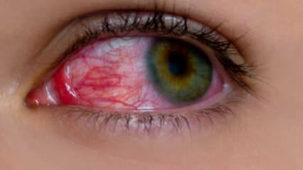 Apa yang menyebabkan alergi mata? Apa saja gejala alergi mata? Apa yang baik untuk alergi mata? 