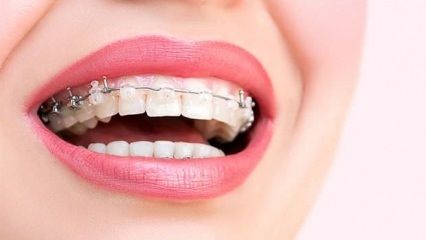 Mengapa kawat gigi terpasang? Apa saja jenis kawat gigi?