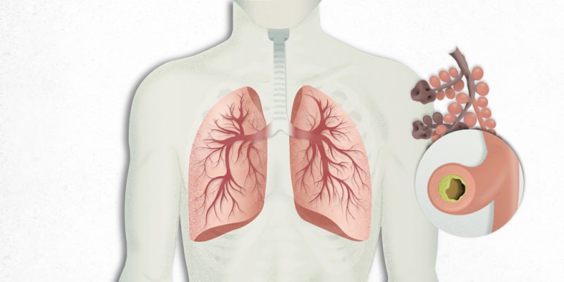 virus yang mengendap di paru-paru bercampur dengan pneumonia