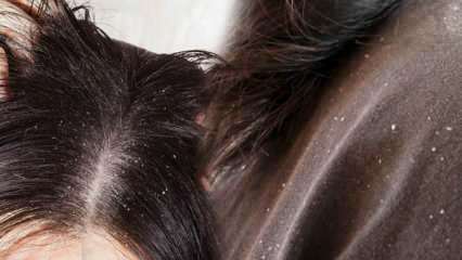 Bagaimana ketombe bisa lolos dan apa yang baik untuk rambut berketombe? 5 metode tercepat dan paling efektif untuk menghilangkan ketombe