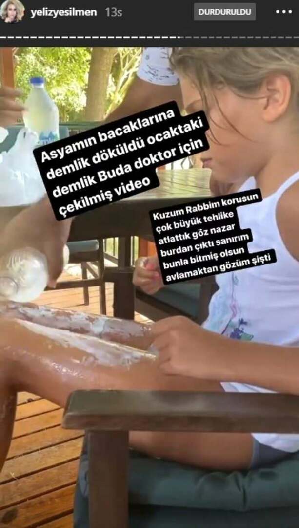 Air mendidih disiramkan ke kaki putri Yeliz Yeşilmen