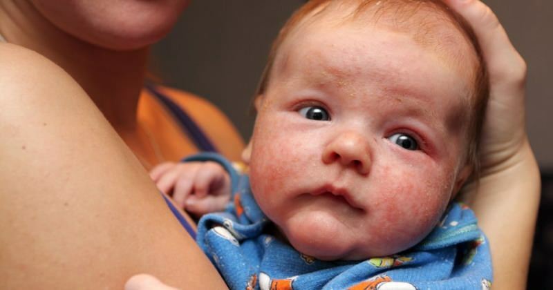 Penyebab mata merah pada bayi