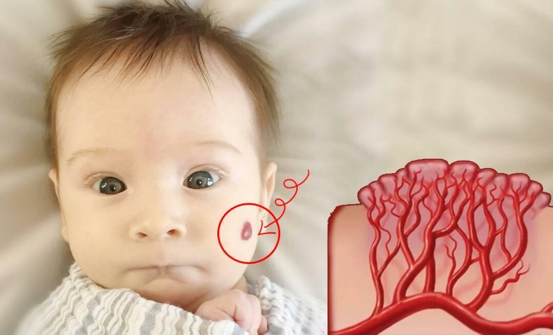 Apa itu hemangioma vena nevi? Apa penyebab hemangioma, apa pengobatannya?