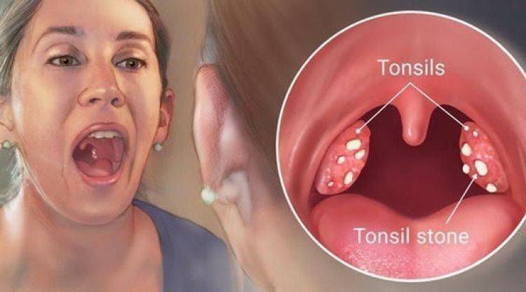 tonsilitis disebut pembengkakan amandel