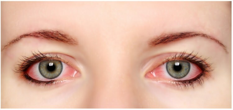 Apakah maskara dan eyeliner alergi di mata?