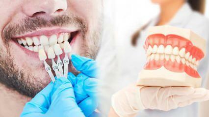 Mengapa lapisan zirkonium diterapkan pada gigi? Seberapa tahan lama lapisan zirkonium?