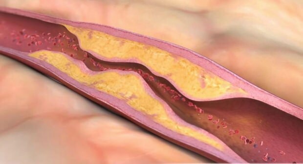 Apa yang menyebabkan aterosklerosis? Ada berapa jenis oklusi vaskular?