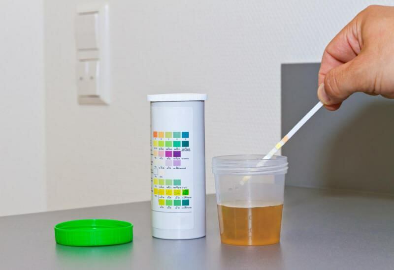 kadar bilirubin biasanya terjadi pada tes urin