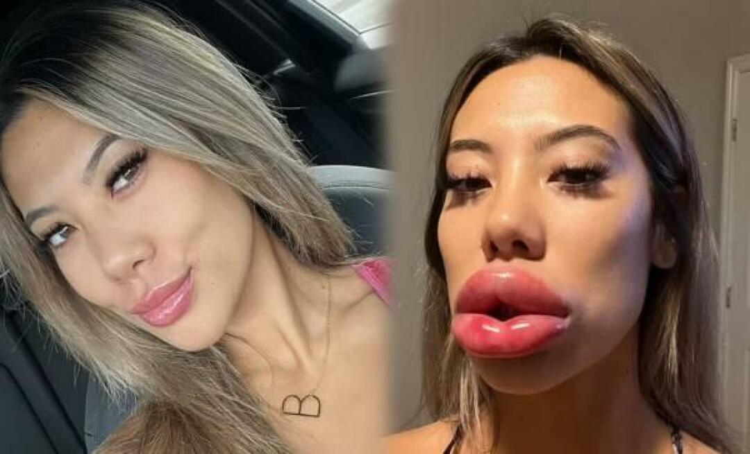 Bibir wanita yang melakukan filler di USA tercengang!