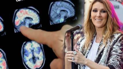 Apa itu sindrom orang kaku? Celine Dion