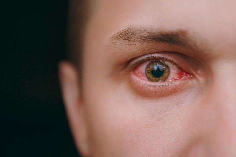 mata berair, pendarahan dan gejala coronavirus yang gatal