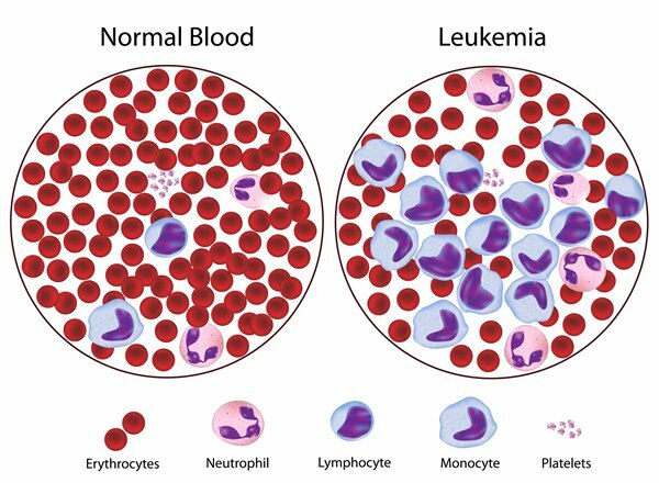 apa itu leukemia
