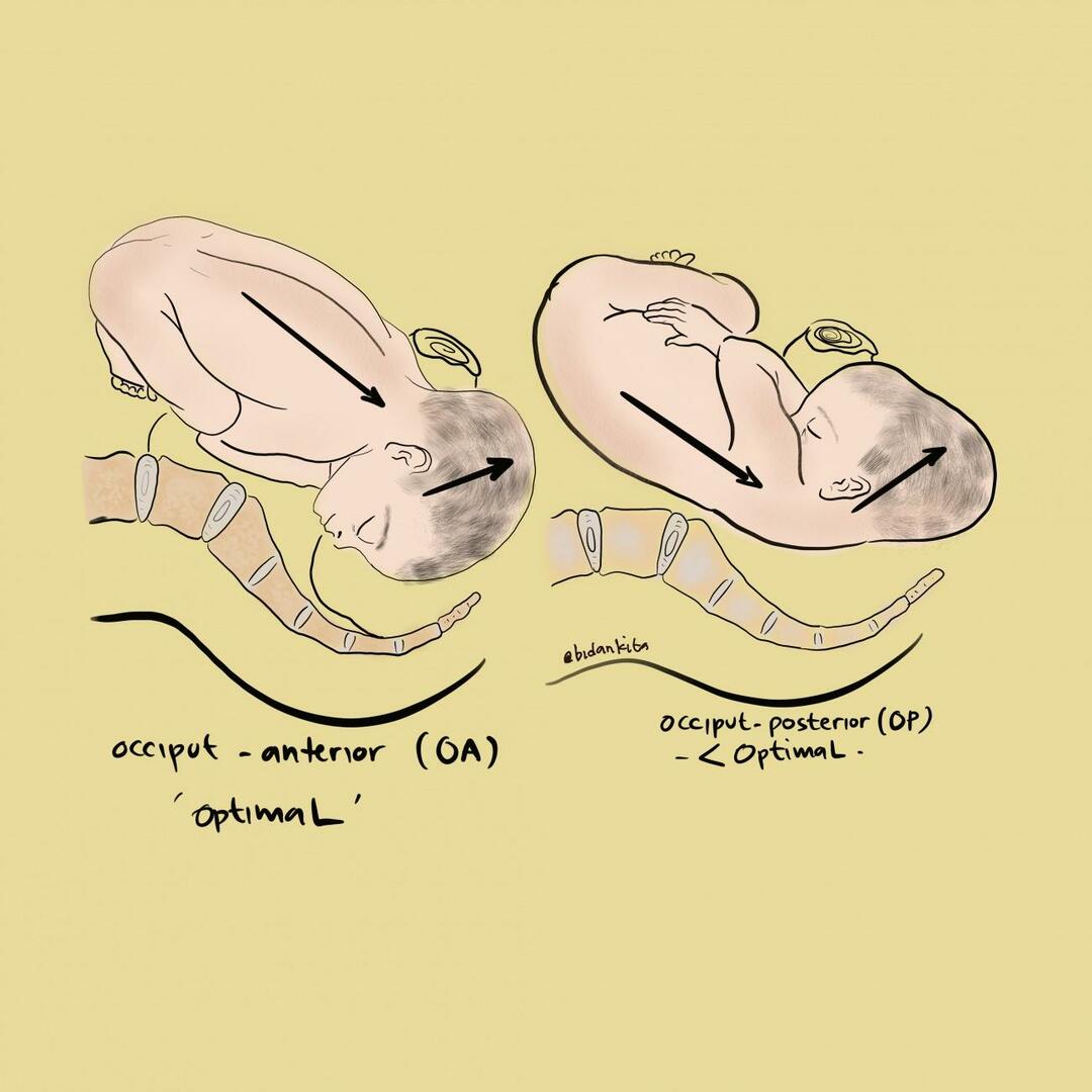 postur oksiput anterior dan oksiput posterior