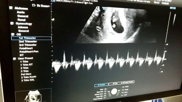 Kapan detak jantung bayi dalam kandungan terdengar? Jika detak jantung bayi tidak terdengar ...