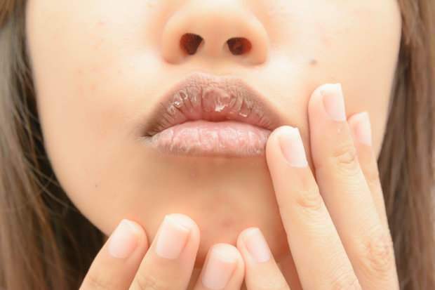 Anemia menyebabkan bibir kering