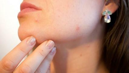 Apa itu kanker kulit (Melanoma)? Apa saja gejala melanoma dan apakah ada obatnya?
