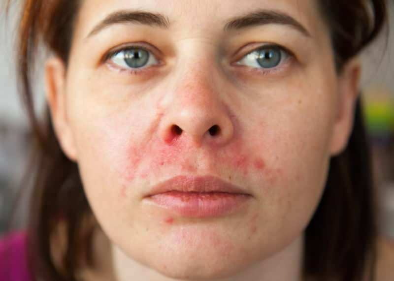 Mengapa jerawat muncul di sekitar bibir? Bagaimana Dermatitis Perioral dirawat?
