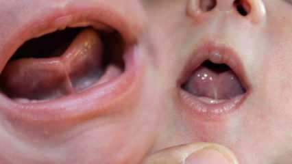 Apa ikatan lidah (Ankyloglossi) pada bayi? Gejala dan pengobatan ikatan lidah ...