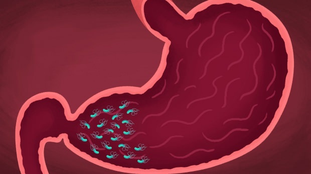beberapa virus dan bakteri dapat menyebabkan gastritis