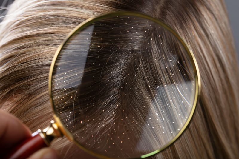 Bagaimana ketombe lulus dan apa yang baik untuk rambut ketombe? 5 obat ketombe tercepat dan paling efektif