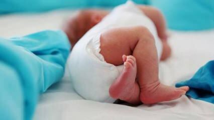 Haruskah bayi melakukan USG pinggul?