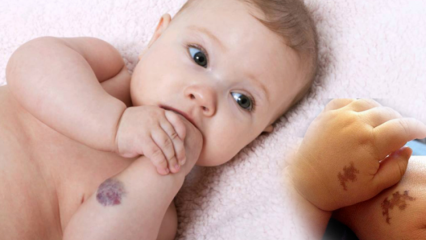 Penyebab tanda lahir pada bayi, apakah itu permanen? Apa saja jenis tanda lahir? Obat dari Saracoglu