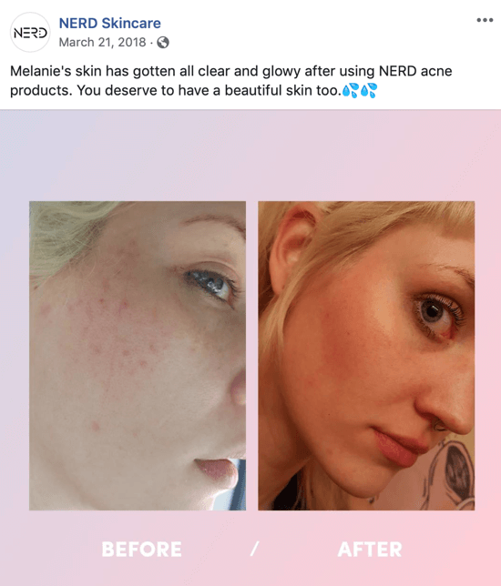 Contoh bagaimana Nerd Skincare menggunakan gambar sebelum dan sesudah untuk membuat postingan gambar di media sosial yang mendorong pembelian produk mereka.