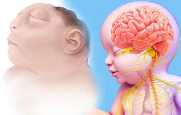 Apakah bayi Anencephaly hidup? Diagnosis anencephaly