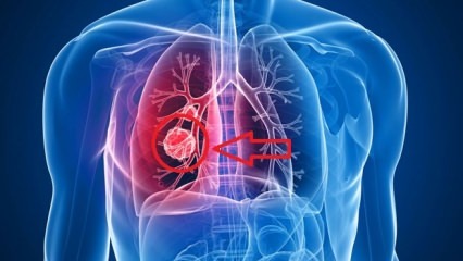 Gejala kanker paru-paru: stadium kanker paru-paru!