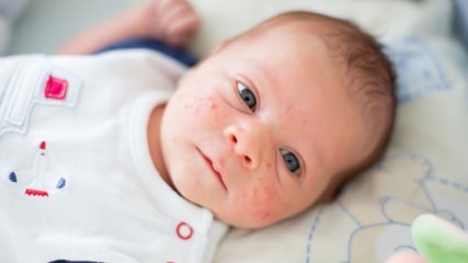 Bagaimana jerawat menyebar di wajah bayi? Metode pengeringan jerawat (Milia)