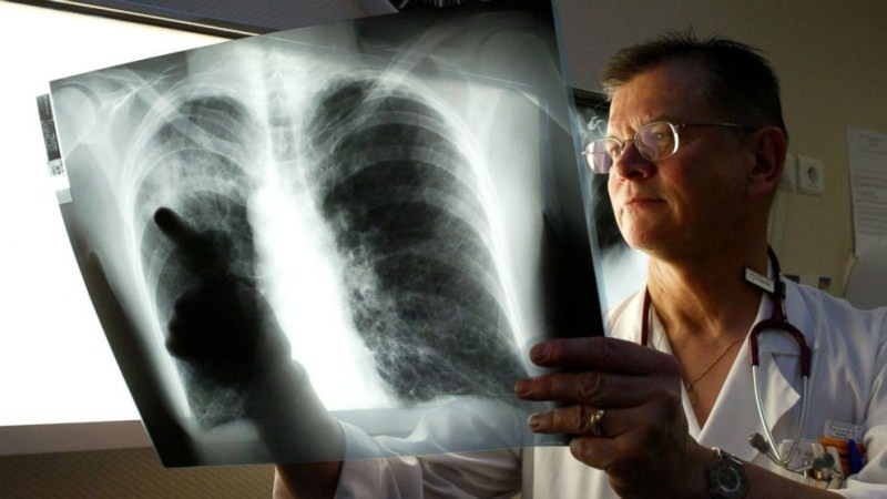 virus legionnaire mengendap di paru-paru 