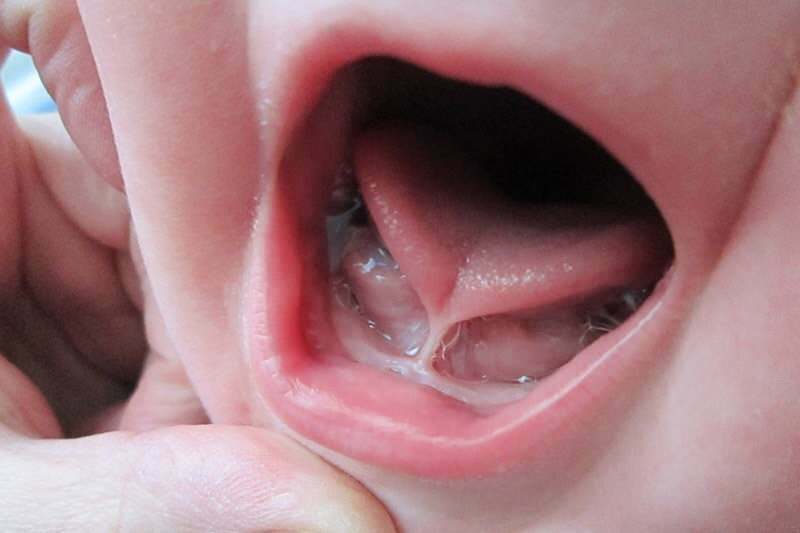Gejala dan pengobatan ikatan lidah pada bayi