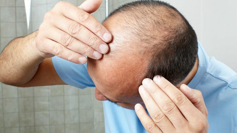 Apakah transplantasi rambut mencegah mandi air?