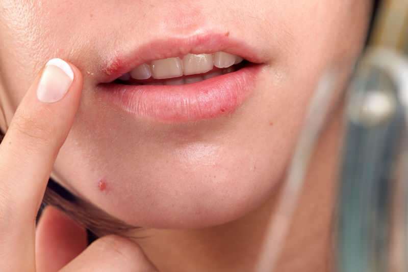 herpes biasanya keluar di tepi bibir.