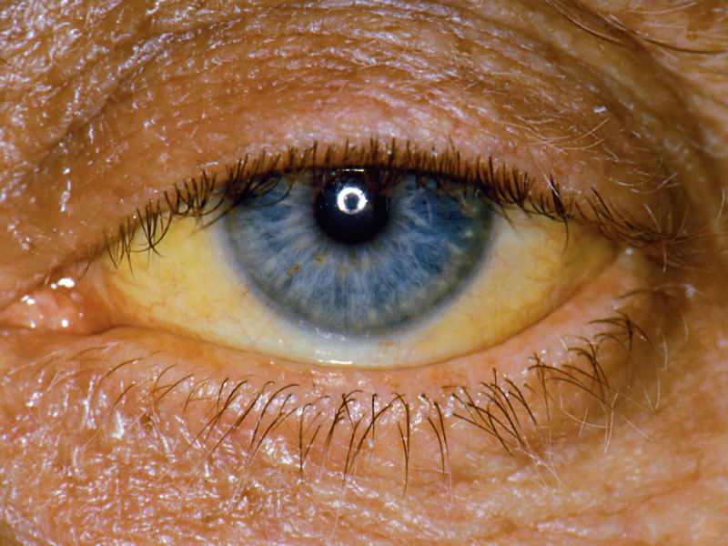 ketinggian pada tingkat bilirubin menyebabkan warna kuning pada mata dan kulit