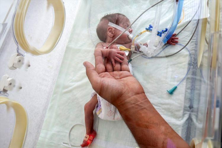 'Miracle baby' berhasil selamat dari operasi
