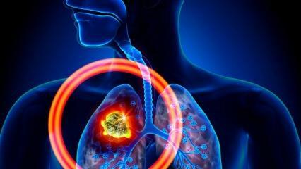 Apa saja gejala kanker paru-paru? Apakah ada pengobatan untuk kanker paru-paru?