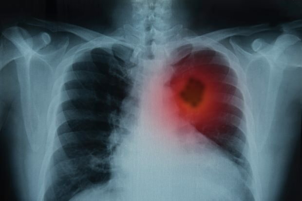 Apa saja gejala kanker paru-paru? Apakah ada pengobatan kanker paru-paru? Untuk mencegah kanker paru-paru ...