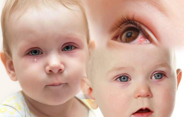 Mengapa mata bayi terkena darah? Bagaimana pendarahan mata terjadi pada bayi yang baru lahir?