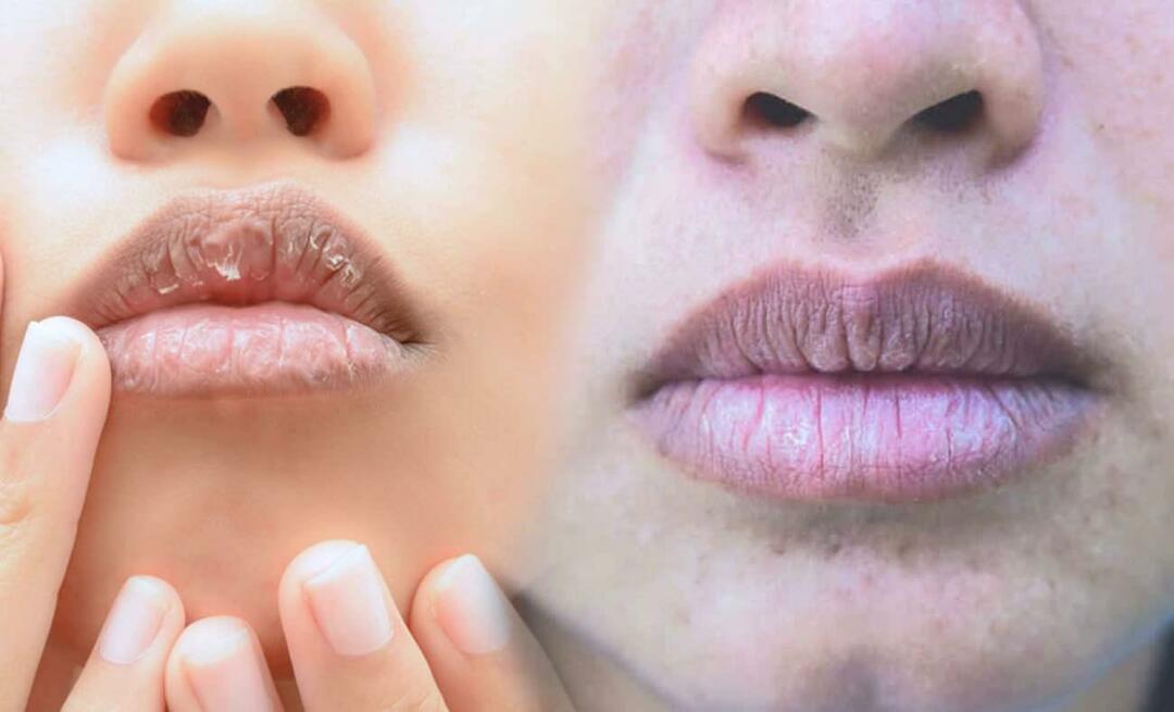 Apa yang menyebabkan bibir gelap? Bagaimana cara merawat bibir yang menghitam atau memar?