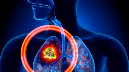 Apa saja gejala kanker paru-paru? Apakah ada pengobatan kanker paru-paru? Untuk mencegah kanker paru-paru ...