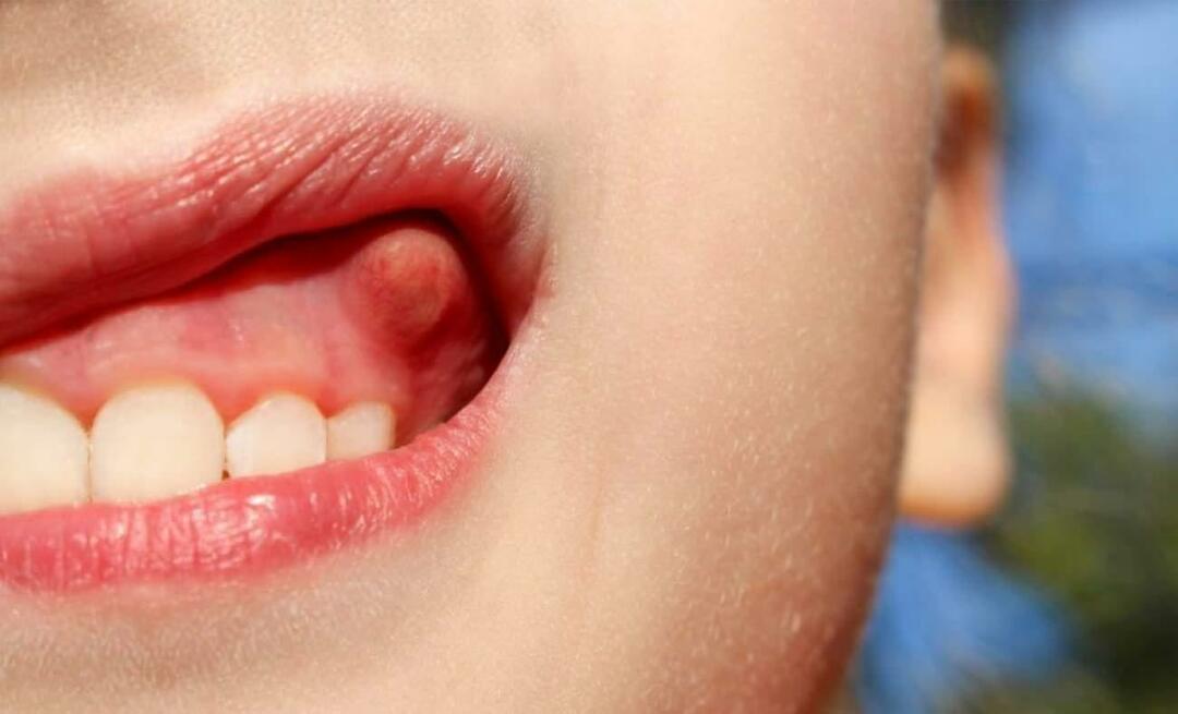 Mengapa abses gigi dan apa gejalanya? Abses gigi, bagaimana pengobatannya?