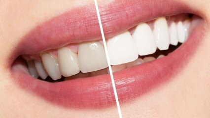 Apa rekomendasi untuk gigi putih? Pemutihan gigi menyembuhkan secara alami di rumah ...