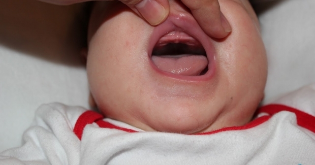 Apa itu drop langit-langit mulut pada bayi, mengapa? Gejala dan pengobatan ...